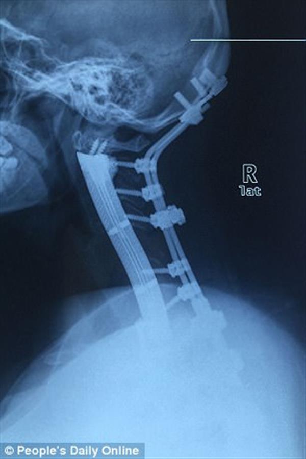 doctors china replace 5 5 inches cancer patient vertebrae titanium 3d printed implants 2 1