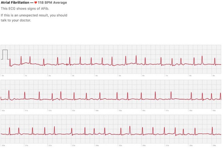 ekg