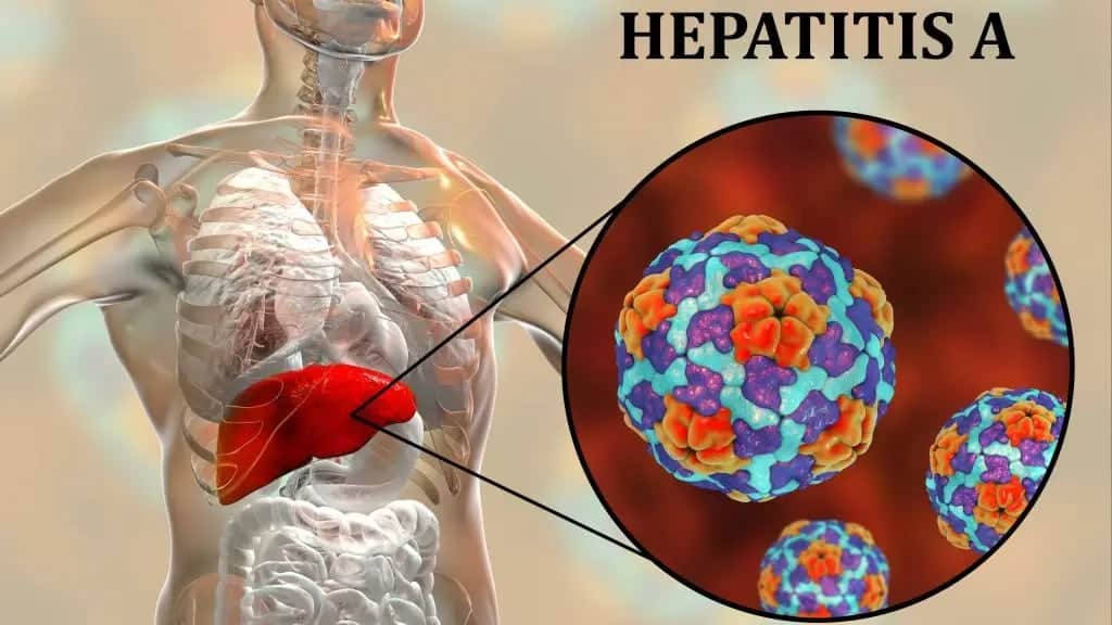 Mimoriadna situácia bola vyhlásená v súvislosti so šírením hepatitídy typu A.