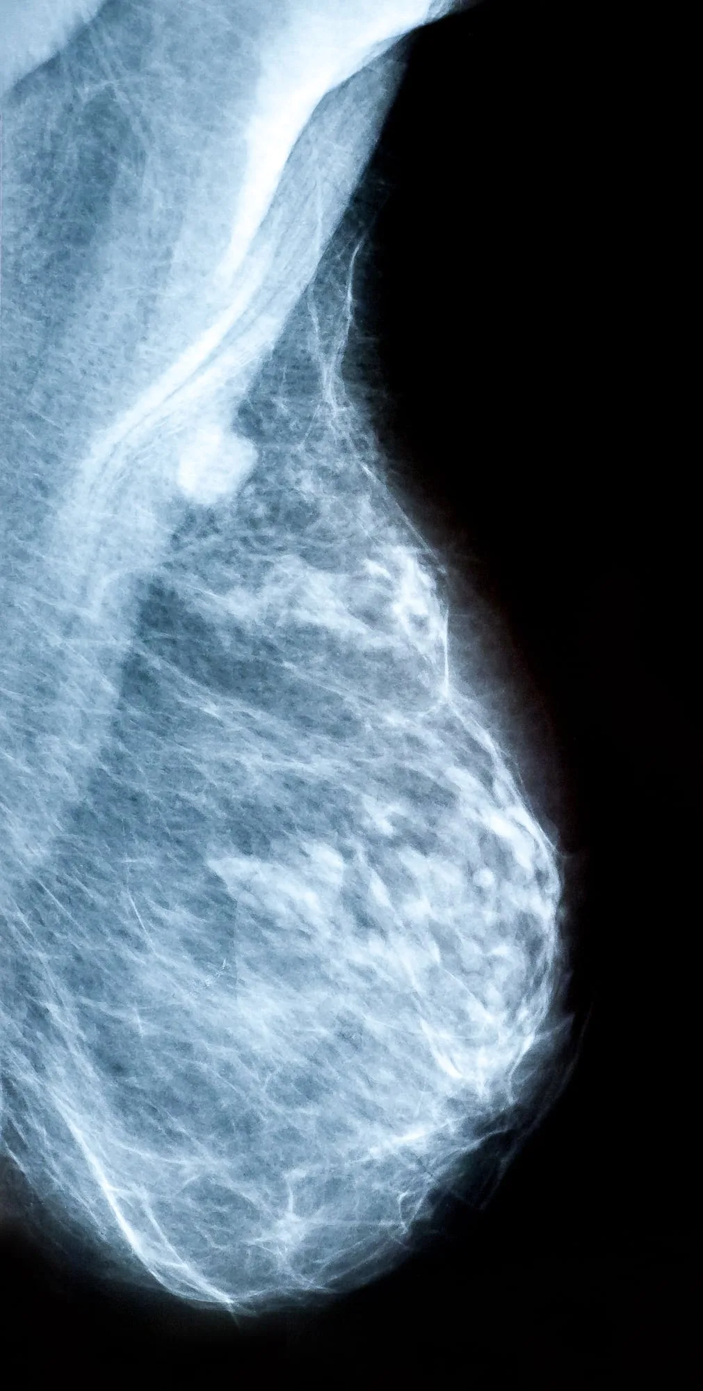 Mamogram