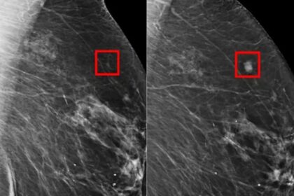 Rakovina prsníka, AI