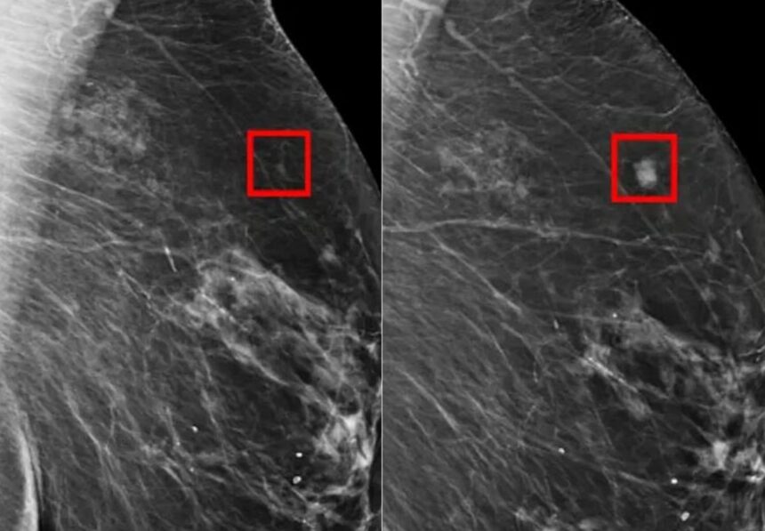 Rakovina prsníka, AI